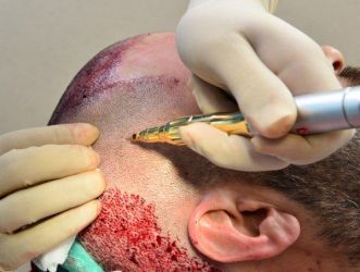 الوجه الخفي لزراعة الشعر في تركيا.. سياحة تغري المغاربة