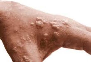 الجزائر ترصد عشرات الإصابات بـمرض جدري القردة