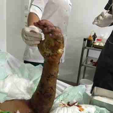فريق طبي مغربي ينجح في إعادة زرع يد شخص بعد بترها بالكامل 